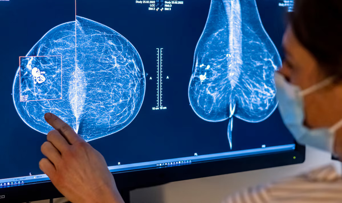 Enhanced Access to Breast Cancer Screenings for Women Aged 40 in Ontario